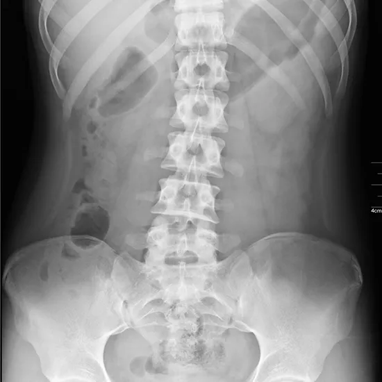 X-Ray Abdomen PA Standing View Procedure